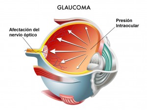 Presión Intraocular afectando al nervio óptico.