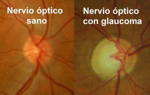 Comparativa fotográfica entre un nervio óptico sano y otro afectado de glaucoma.