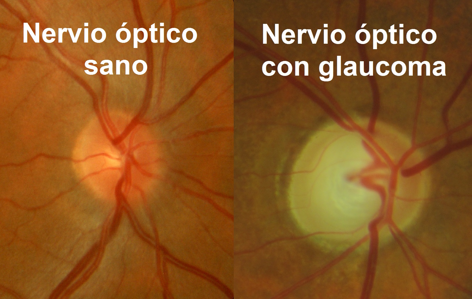 Nervio óptico Sano vs Glaucoma - Vista Camacho Oftalmólogos
